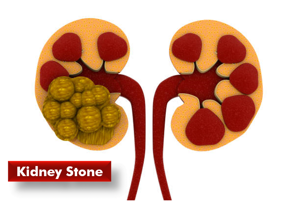 Kidney stone
